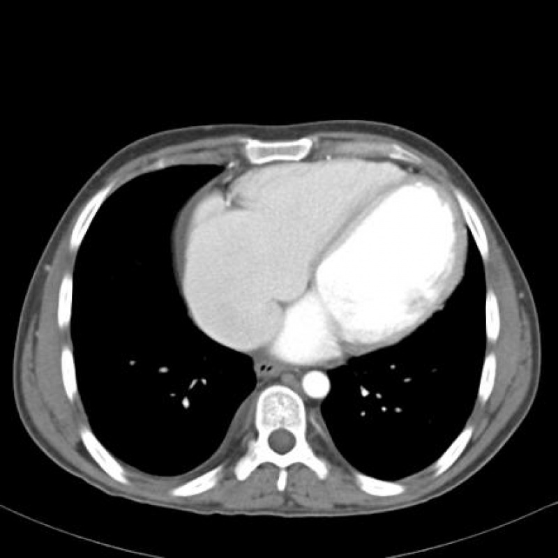 Clínica de Cardiologia para Tratar Miocardites Piracicaba - Clínica de Cardiologia para Tratar Miocardiopatia