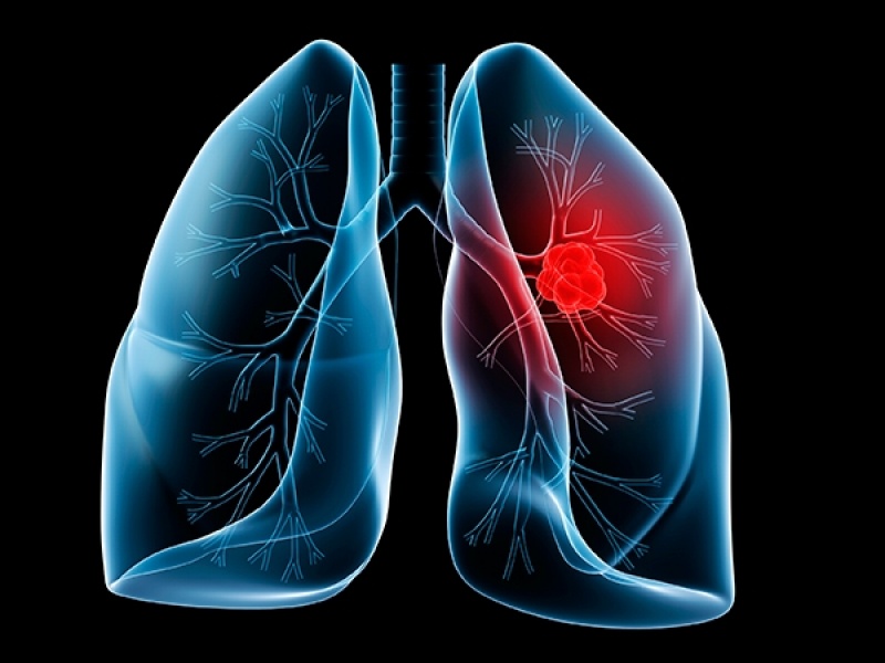 Clínica de Pneumologia para Tratar Apneia Taubaté - Clínica de Pneumologia para Tratar Embolia Pulmonar