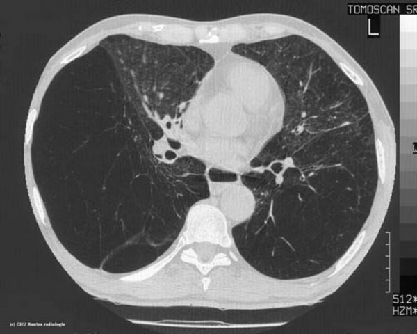 Clínica de Pneumologia para Tratar Enfisema Pulmonar Arujá - Clínica de Pneumologia para Bronquite Asmática