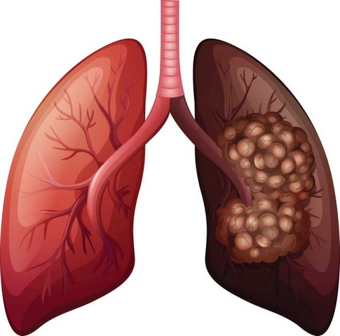 Consulta no Pneumologista Suzano - Consulta com Pneumologista