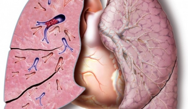 Onde Encontrar Clínica de Pneumologia para Tratar Embolia Pulmonar Valinhos - Clínica Particular ao Pneumologista