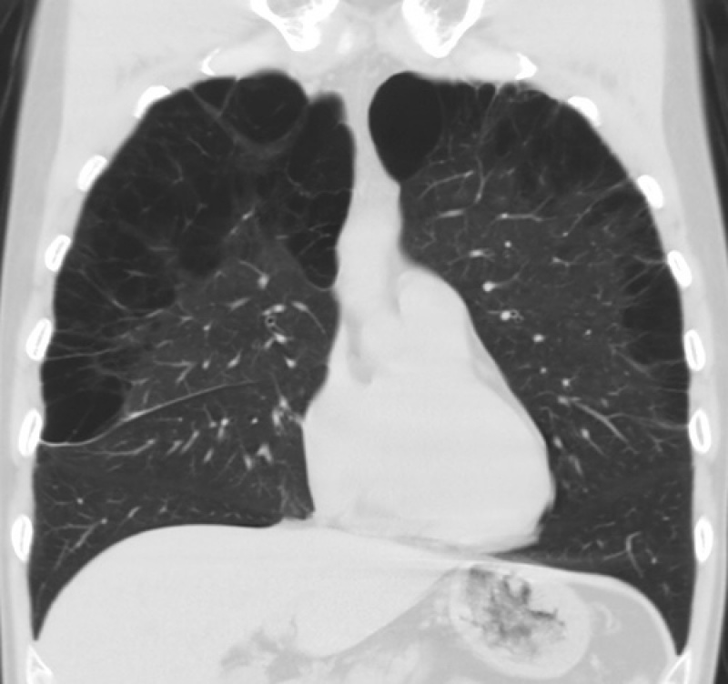 Onde Encontrar Clínica de Pneumologia para Tratar Enfisema Pulmonar Santo André - Clínica de Pneumologia para Bronquite
