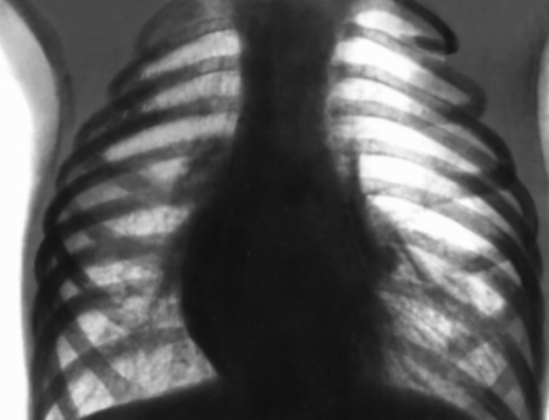 Onde Encontrar Clínica de Pneumologia Particular Diadema - Clínica de Pneumologia para Bronquite