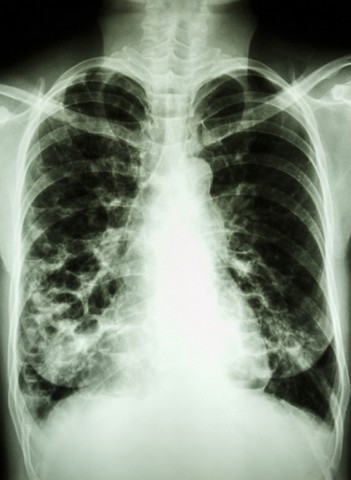 Onde Encontrar Clínica Médica com Pneumologia Paulínia - Clínica de Pneumologia para Tratar Embolia Pulmonar