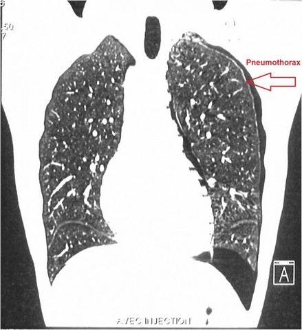 Onde Encontrar Clínica Particular ao Pneumologista Arujá - Clínica de Pneumologia para Bronquite Asmática