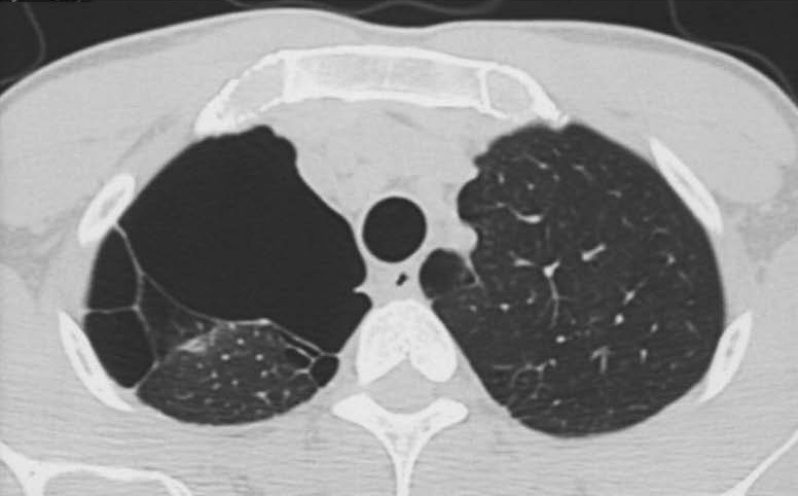 Onde Encontrar Consulta Pneumologista para Tratar Enfisema Pulmonar São Carlos - Consulta ao Pneumologista para Tosse Seca