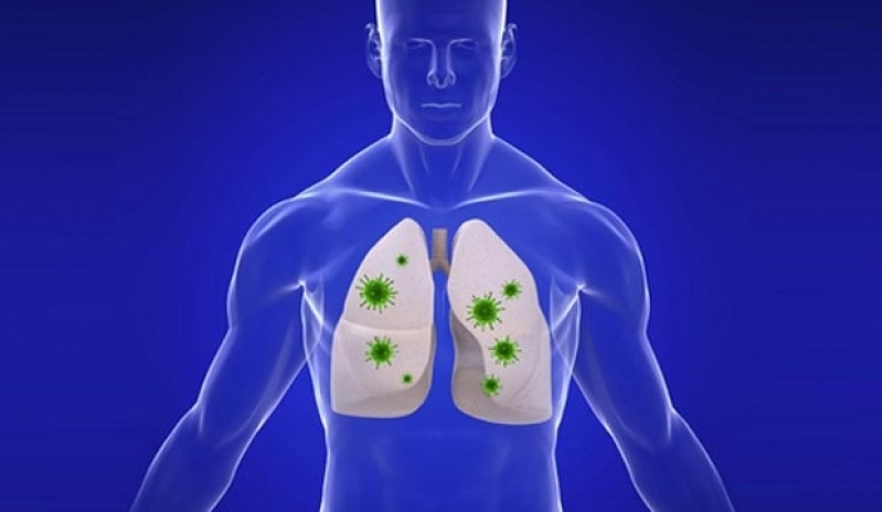 Onde Encontro Clínica de Pneumologia para Bronquite Asmática Marapoama - Clínica de Pneumologia para Bronquite Asmática