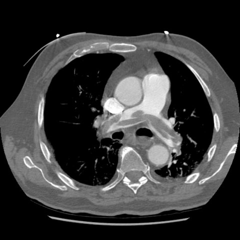 Onde Encontro Clínica de Pneumologia para Tratar Embolia Pulmonar Bauru - Clínica Médica com Pneumologia