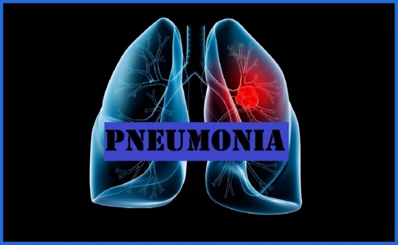 Onde Encontro Clínica Médica com Pneumologia Mendonça - Clínica de Pneumologia para Bronquite