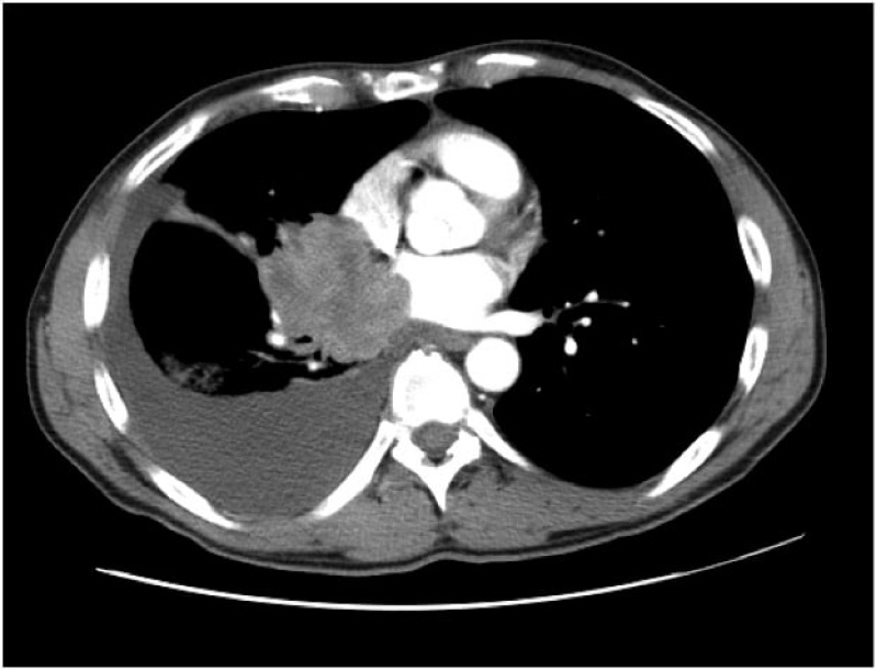 Onde Encontro Clínicas de Pneumologista para Derrame Pleural Vargem Grande Paulista - Clínicas de Pneumologista para Derrame Pleural