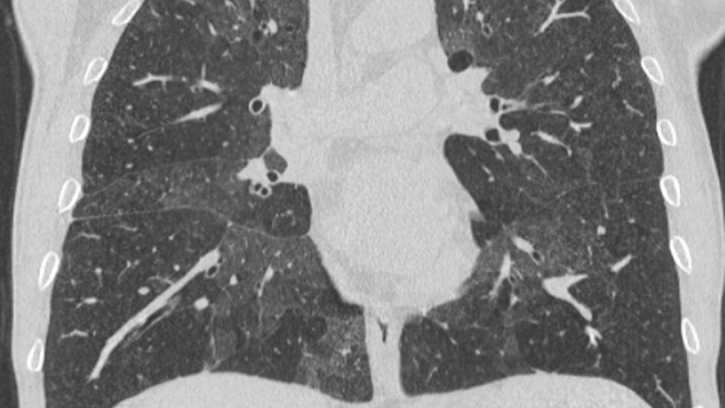 Quanto Custa Consulta Pneumologista para Bronquite Franca - Consulta ao Pneumologista para Pneumonia