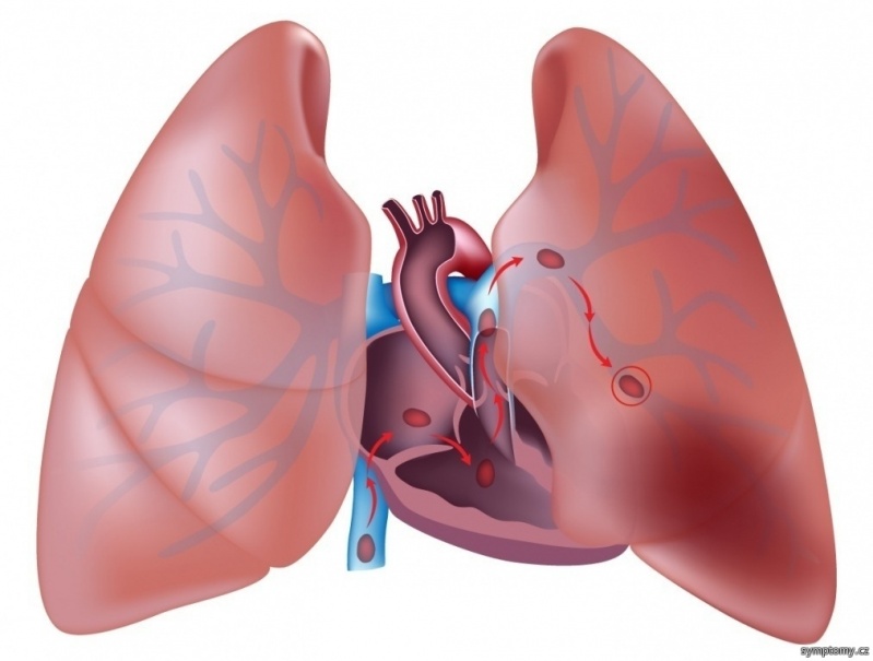 Quanto Custa Consulta Pneumologista para Tratar Embolia Pulmonar Presidente Prudente - Consulta ao Pneumologista para Pneumonia