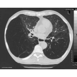 clínica de pneumologia para tratar enfisema pulmonar Francisco Morato