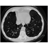 clínica para tratamento para enfisema pulmonar Ribeirão Preto