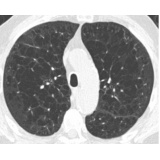 Pneumologista Especialista em Fibrose Pulmonar