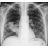 onde encontrar consulta ao pneumologista para tosse seca Juquitiba