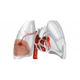 onde encontrar consulta pneumologista para tratar embolia pulmonar Caierias