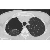 onde encontrar consulta pneumologista para tratar enfisema pulmonar Marapoama