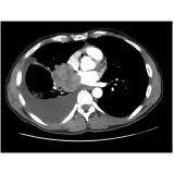onde encontro clínicas de pneumologista para derrame pleural Rio Claro