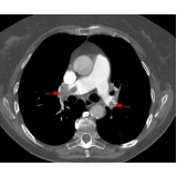 onde encontro pneumologista especialista em embolia pulmonar Itupeva