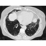 onde encontro pneumologista especialista em fibrose pulmonar Taboão da Serra