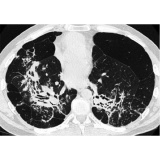 onde encontro pneumologista especialista em sarcoidose São Lourenço da Serra