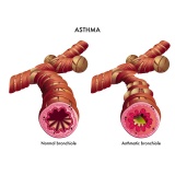 pneumologista especialista em asma Marapoama