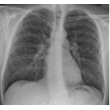 pneumologista especialista em sarcoidose Itapecerica da Serra