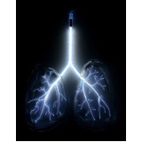 quanto custa consulta pneumologista para tratar bronquite São Caetano do Sul