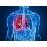tratamento para nódulos no pulmão Santa Isabel