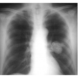 tratamento para nódulos no pulmão